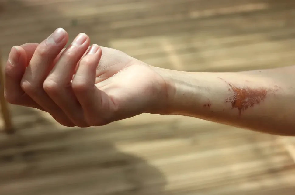 Qué hacer ante una quemadura: Fotografía de una persona extendiendo la mano donde se ve una qu n bn emadura en el antebrazo.